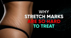 Perfect-B-Blog-PDRN-for-Stretch-Marks-portrait