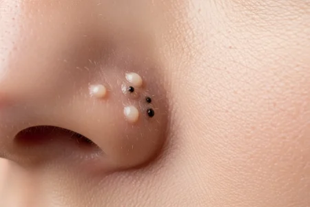 Perfect B - Blog - Whitehead vs Blackhead - Close-up of a nose showing open blackheads and closed whiteheads side by side