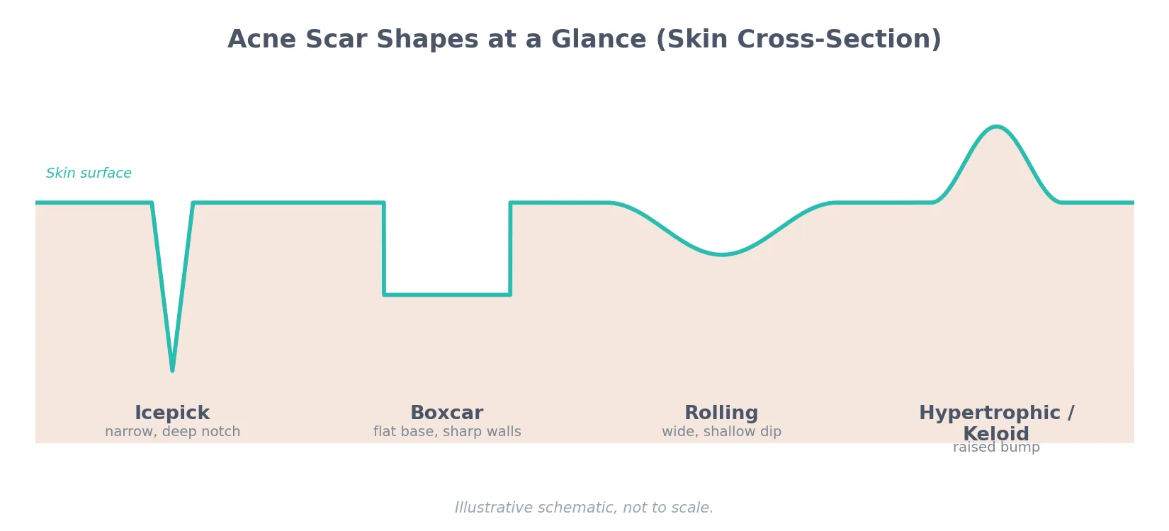 Perfect B - Blog - Pimple Scars - cross-section schematic comparing icepick, boxcar, rolling, and hypertrophic acne scar shapes